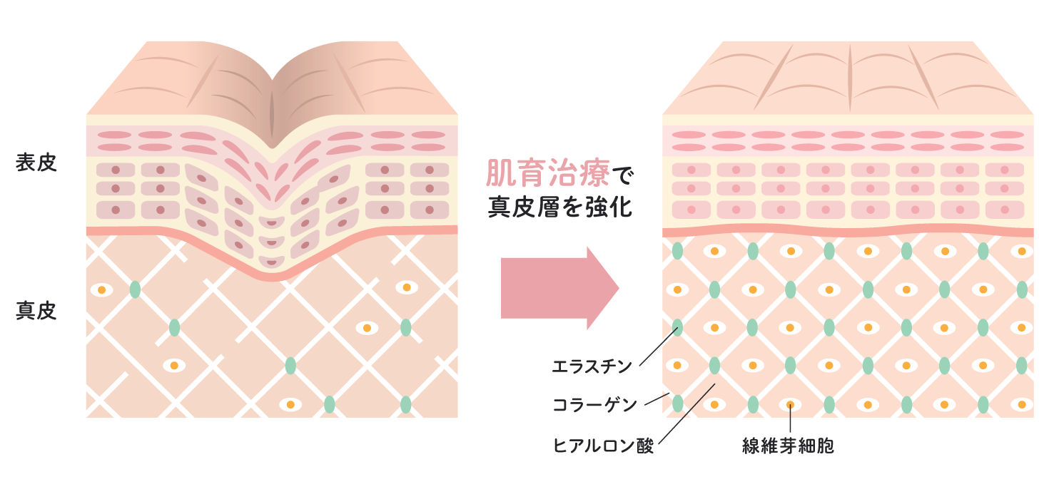 肌育治療とは